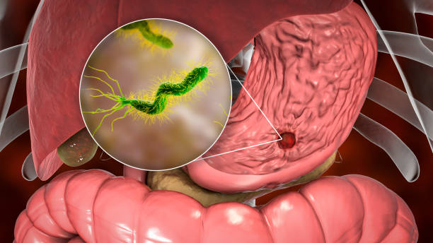 Gastrointestinal (GI) Bleeding