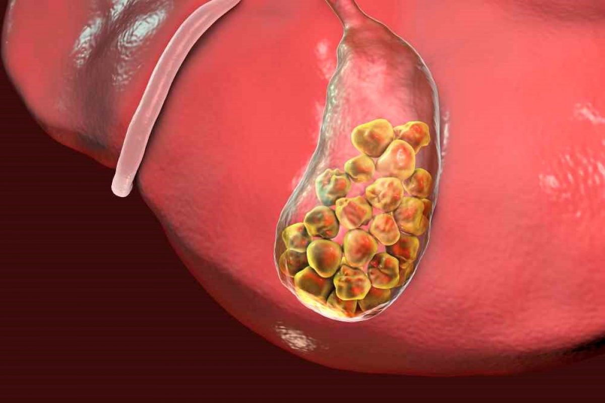 Gallbladder Stone