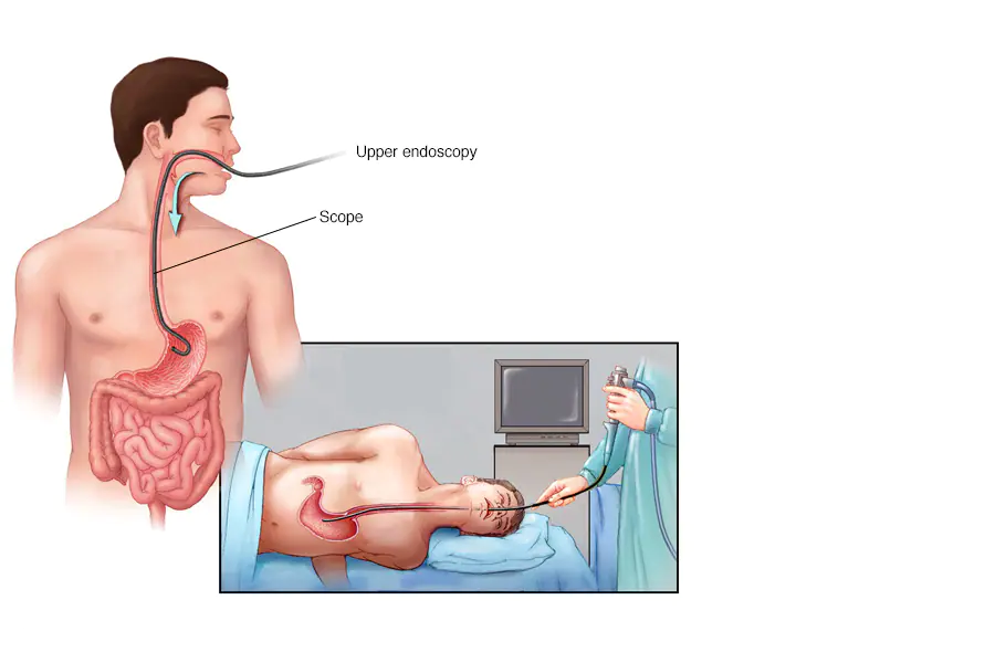 Upper GI Endoscopy