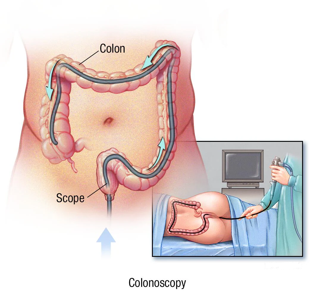 colonoscopy