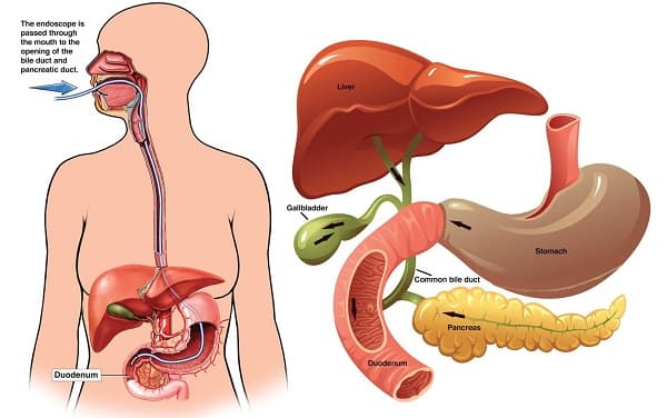 ERCP Treatment