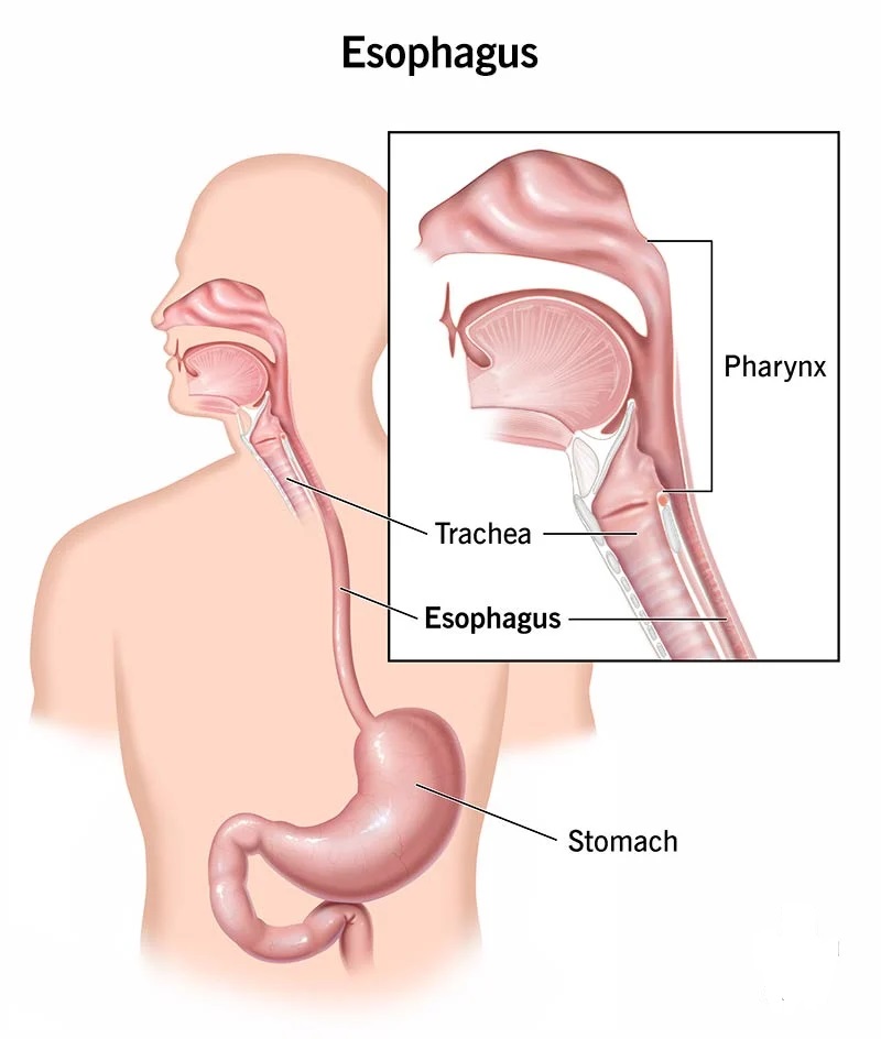 Esophageal Stent Procedure 2